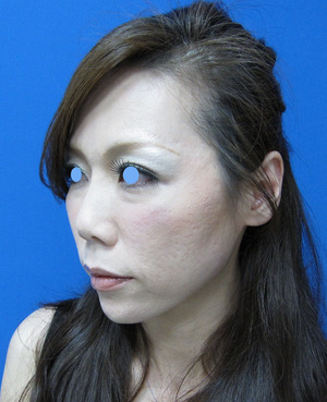 目の下のたるみ、目のくまでお悩みの方、切らずに完璧に解決します。TCB-R法　手術直後　症例写真